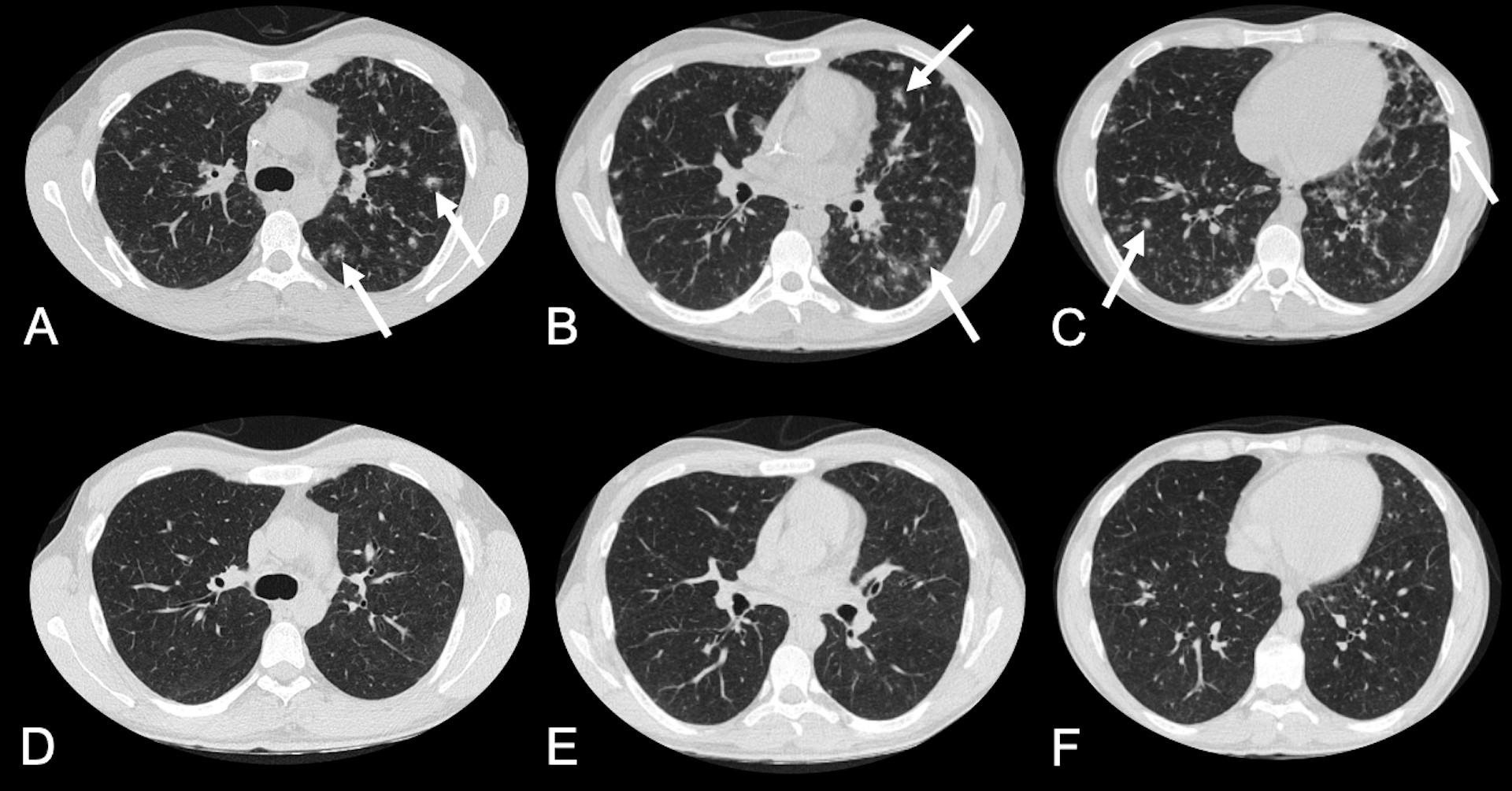 Multiple lung nodules with the halo sign due to syphilis