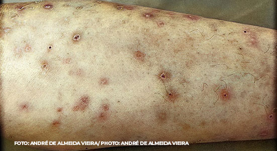 Disseminated miliary tuberculosis with cutaneous involvement in a patient with HIV