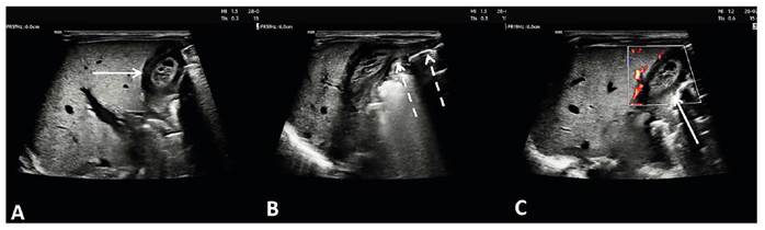 Thrombosed umbilical vein varix in newborn with congenital syphilis