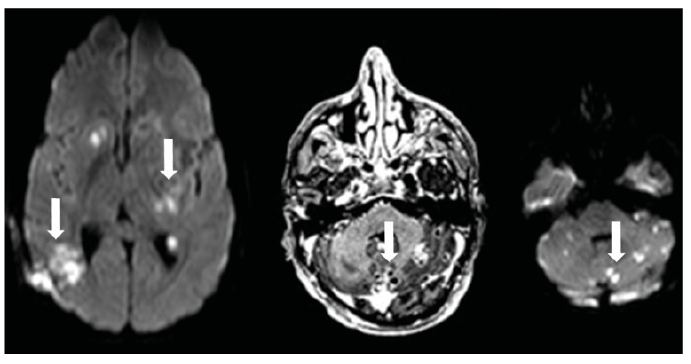 Aspergillus encephalitis with microabscesses in an immunocompetent patient