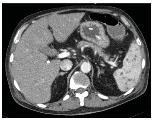Splenic abscesses complicating acute septicemic melioidosis