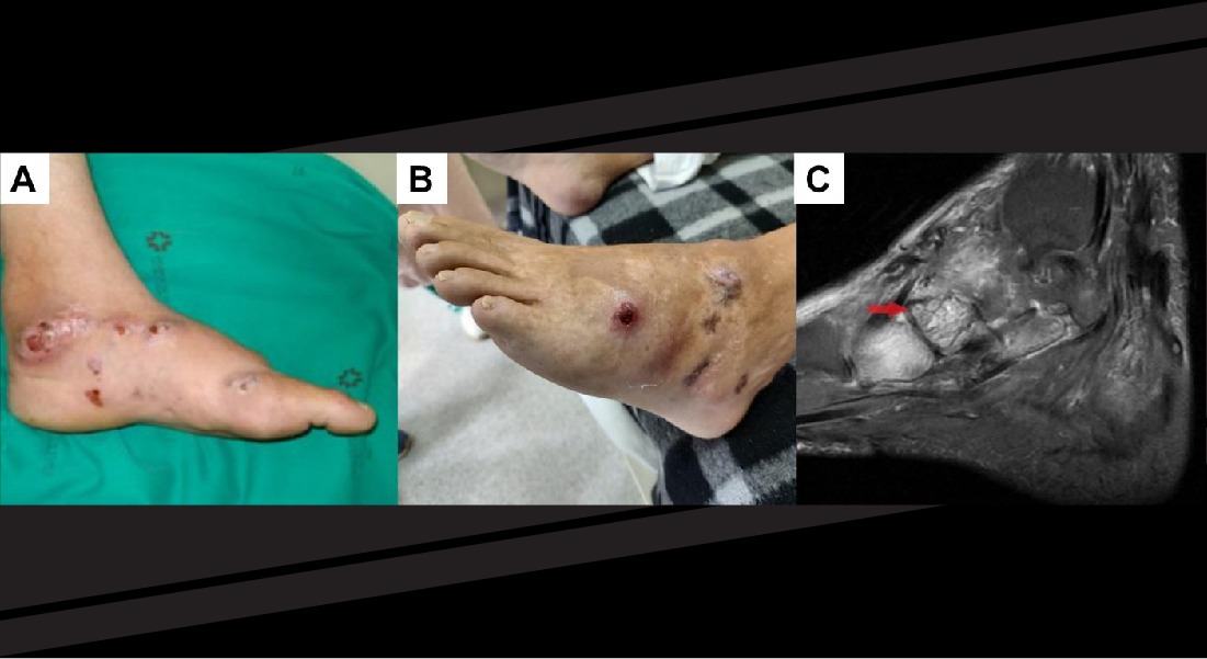 Case report: Mycetoma caused by Gordonia soli