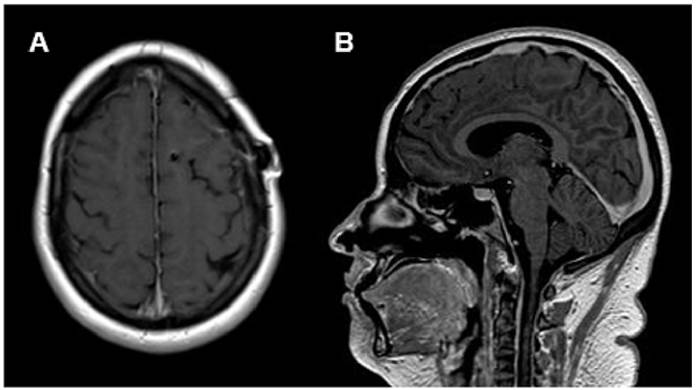 Post-infectious inflammatory response syndrome related to cryptococcal meningoencephalitis