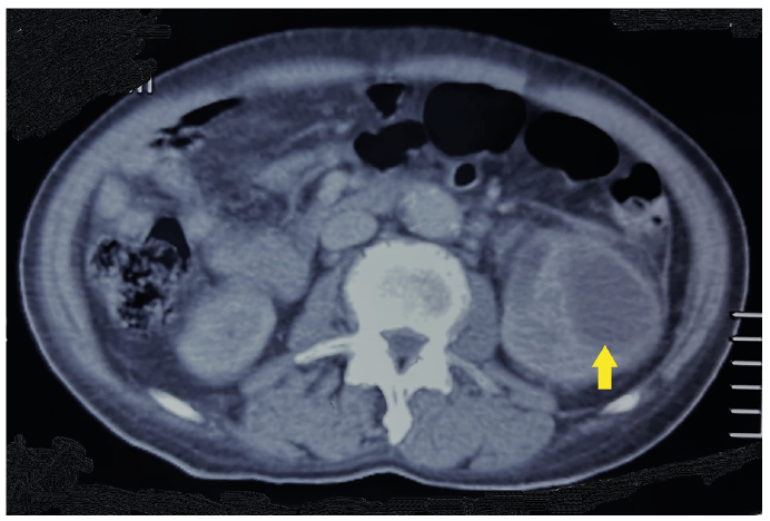 Candida albicans renal abscesses predisposed by staghorn calculi