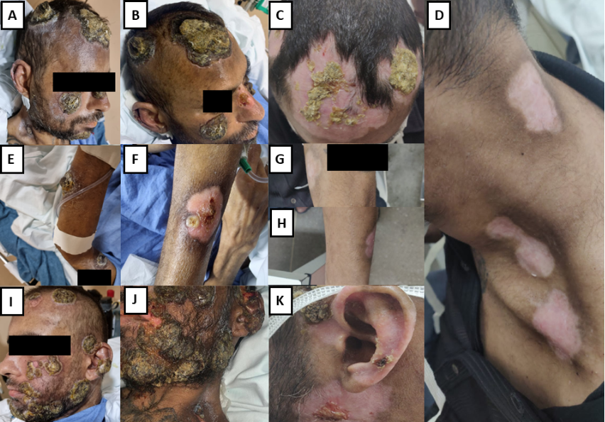 Severe mpox in patients with advanced AIDS: long-term disease and fatal outcome