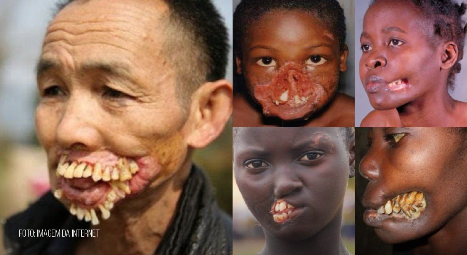 Face da pobreza: doença que destrói rosto de crianças pode entrar para a lista de DTN da OMS