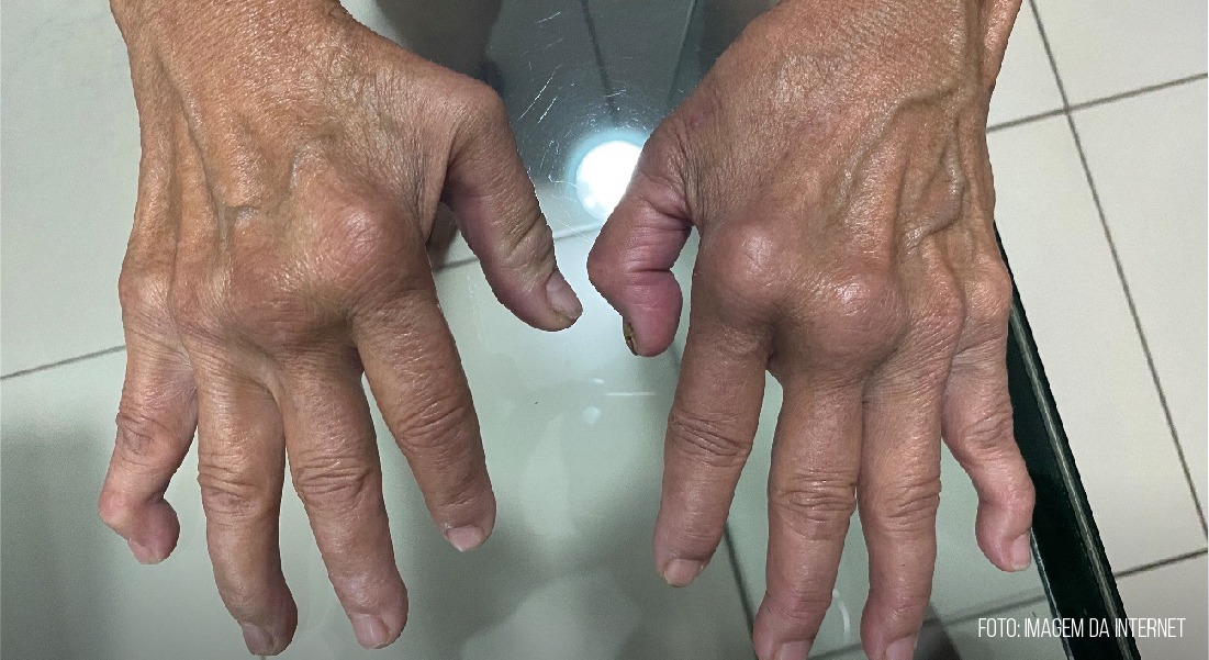 Artigo demonstra similaridades entre artrite reumatoide e artrite crônica chikungunya