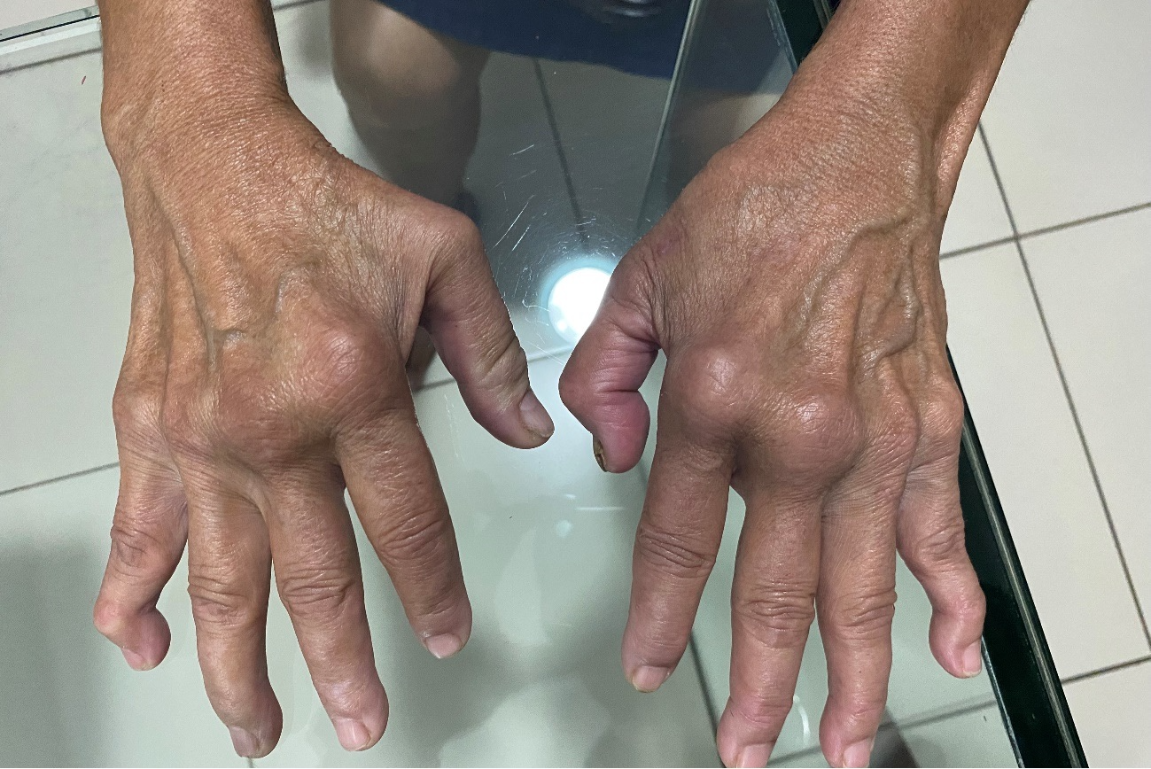 Artigo demonstra similaridades entre artrite reumatoide e artrite crônica chikungunya