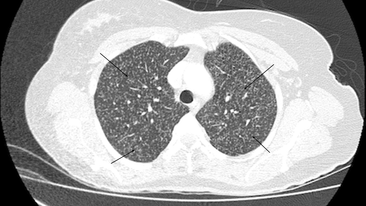 Paracoccidioidomycosis: An uncommon cause of discitis in lupus