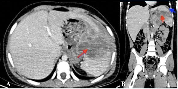 Paediatric Splenic Abscess Due to Salmonella