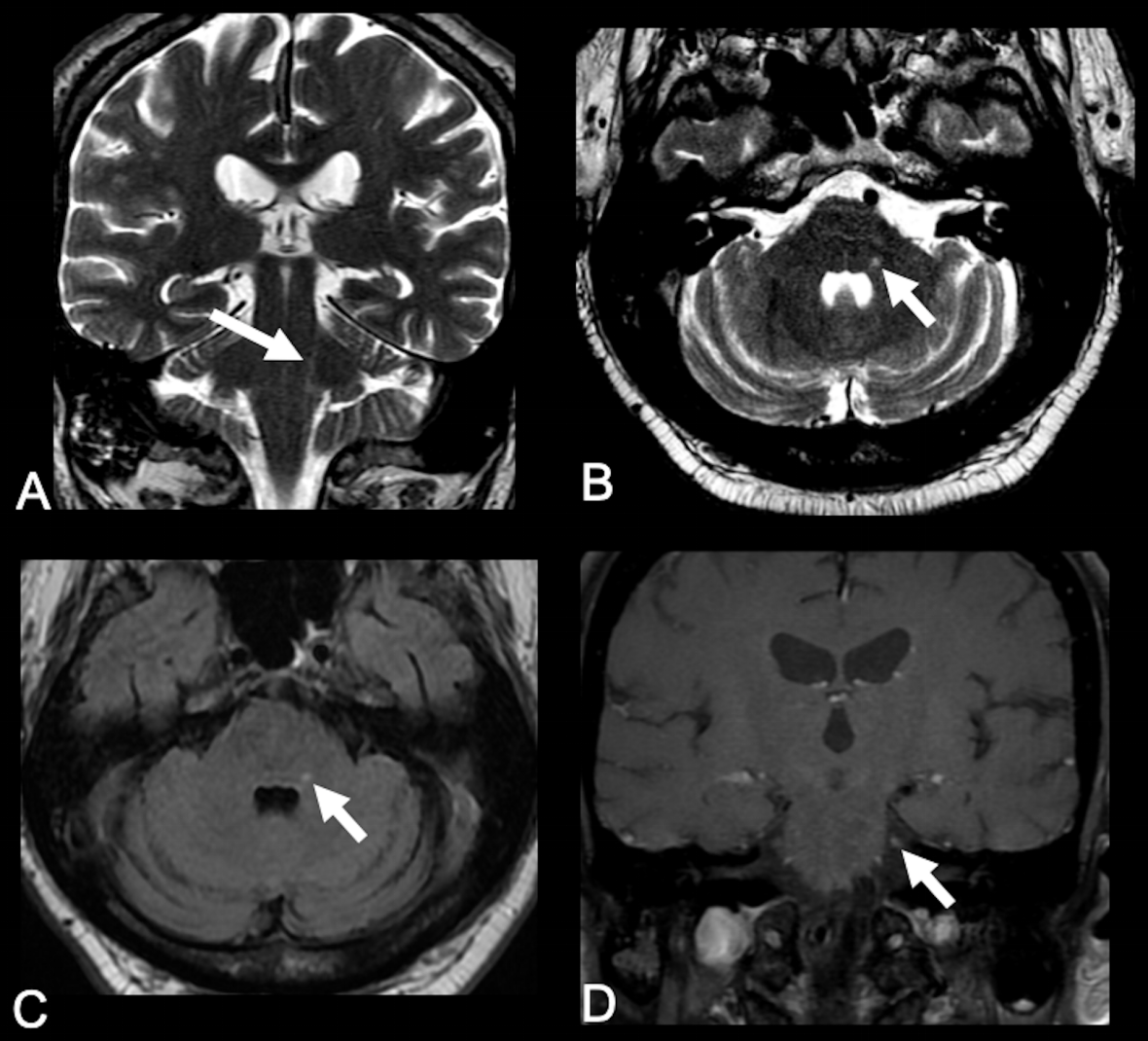 Trigeminal neuralgia due to Varicella-zoster virus reactivation