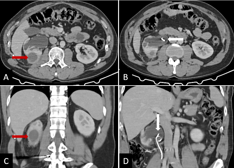 Renal abscess in a patient with a long-term double-J stent due to Candida albicans