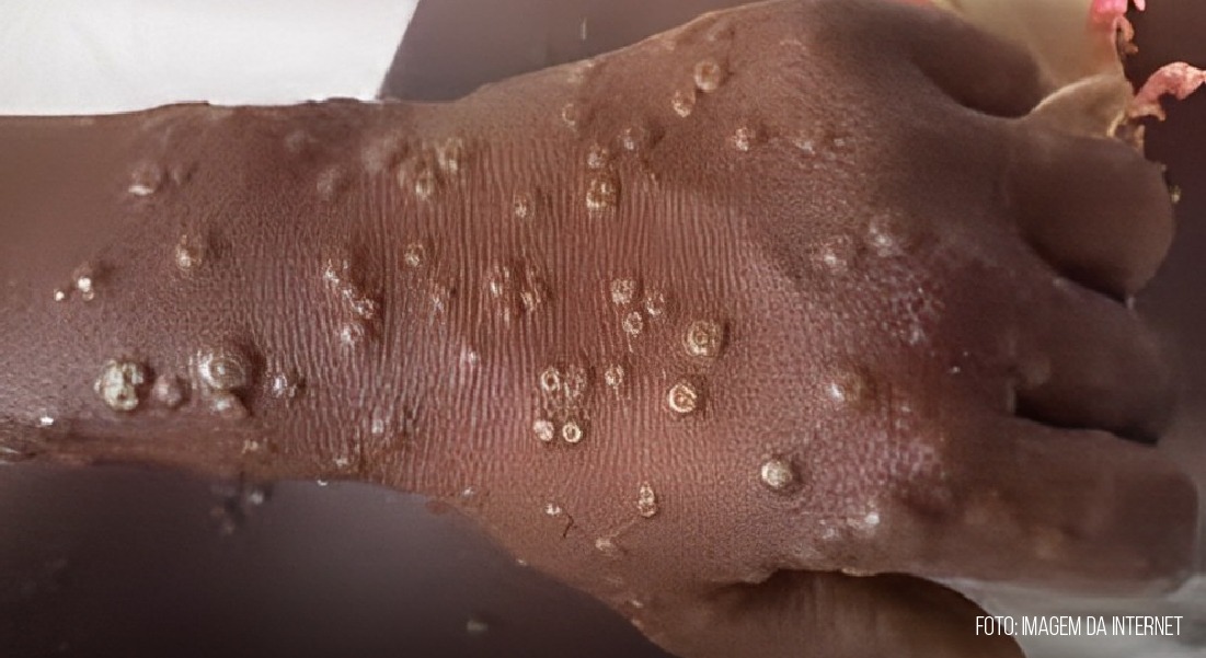 Monkeypox: pesquisa brasileira abre caminho para profilaxia e prevenção