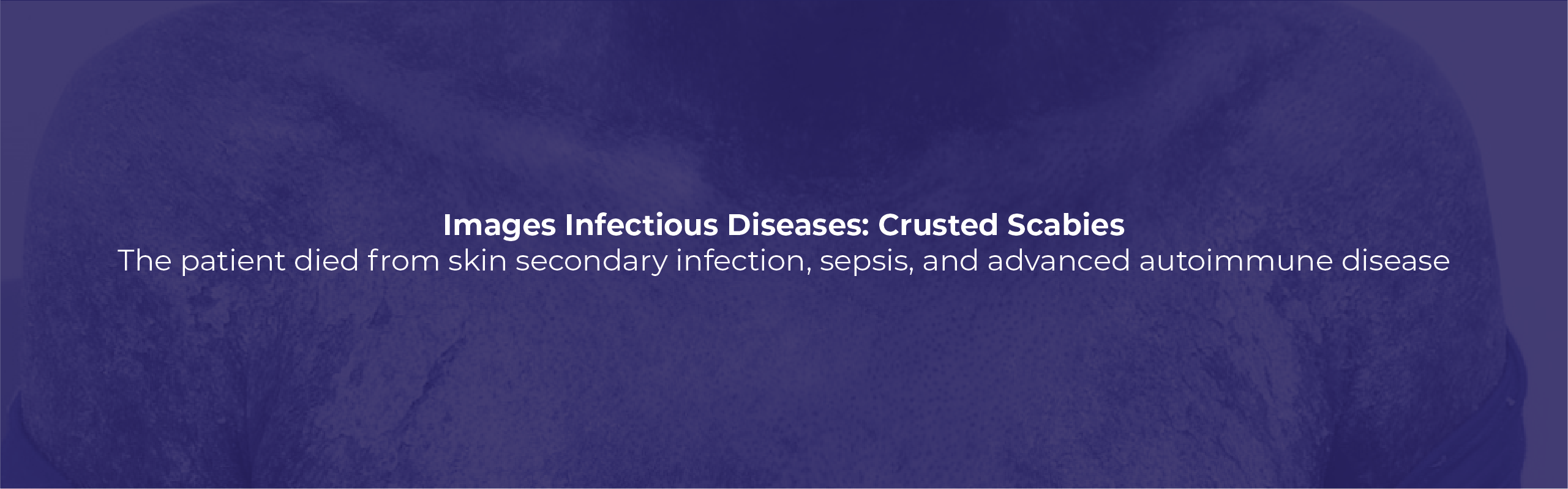 IMAGES INFECTIOUS DISEASES: CRUSTED SCABIES