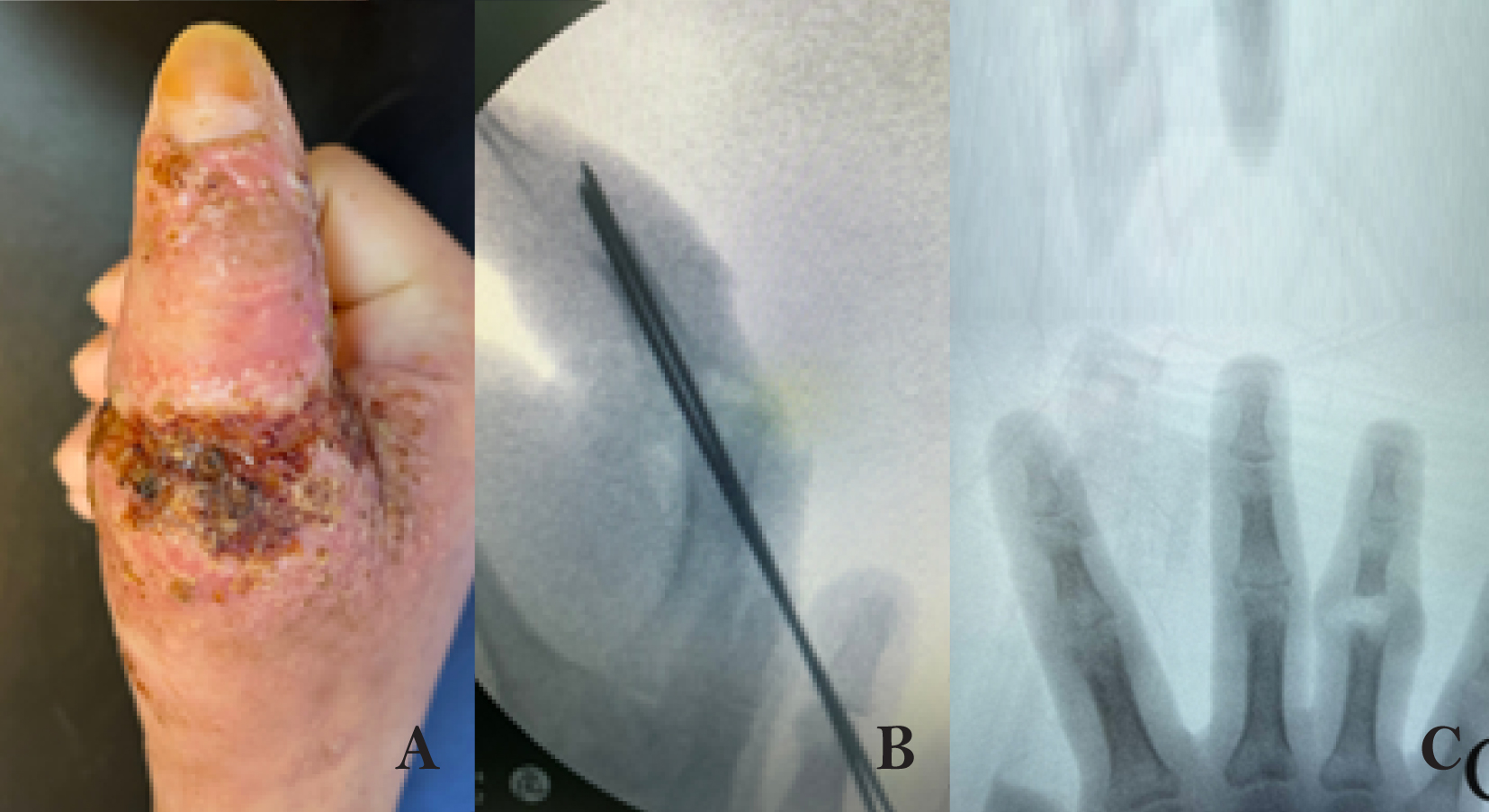 Disseminated sporotrichosis with osteoarticular involvement in a patient with acquired immunodeficiency syndrome: a case report