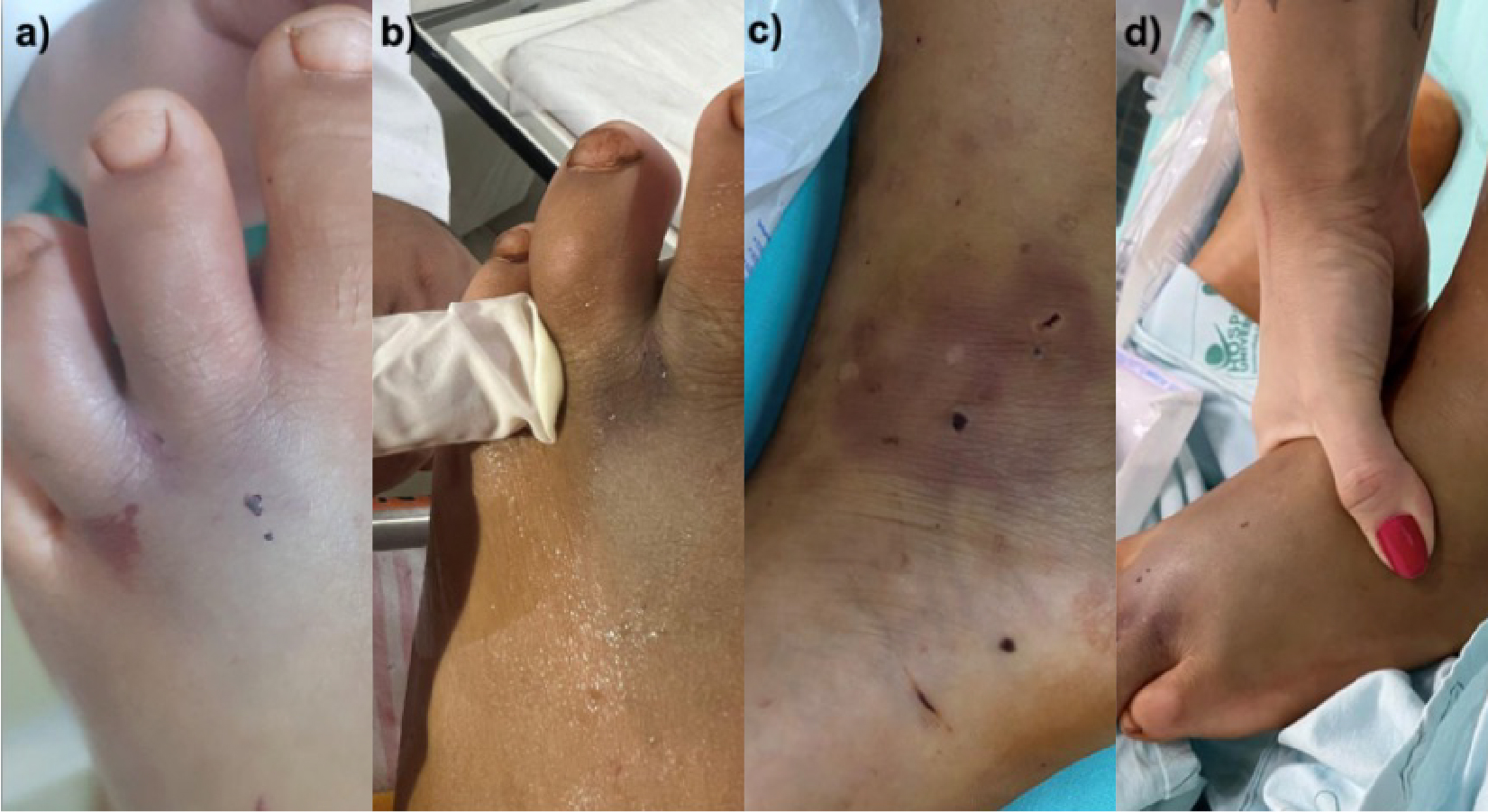 Brain death due to intracranial hemorrhage in a child following suspected Bothrops snakebite: Case Report