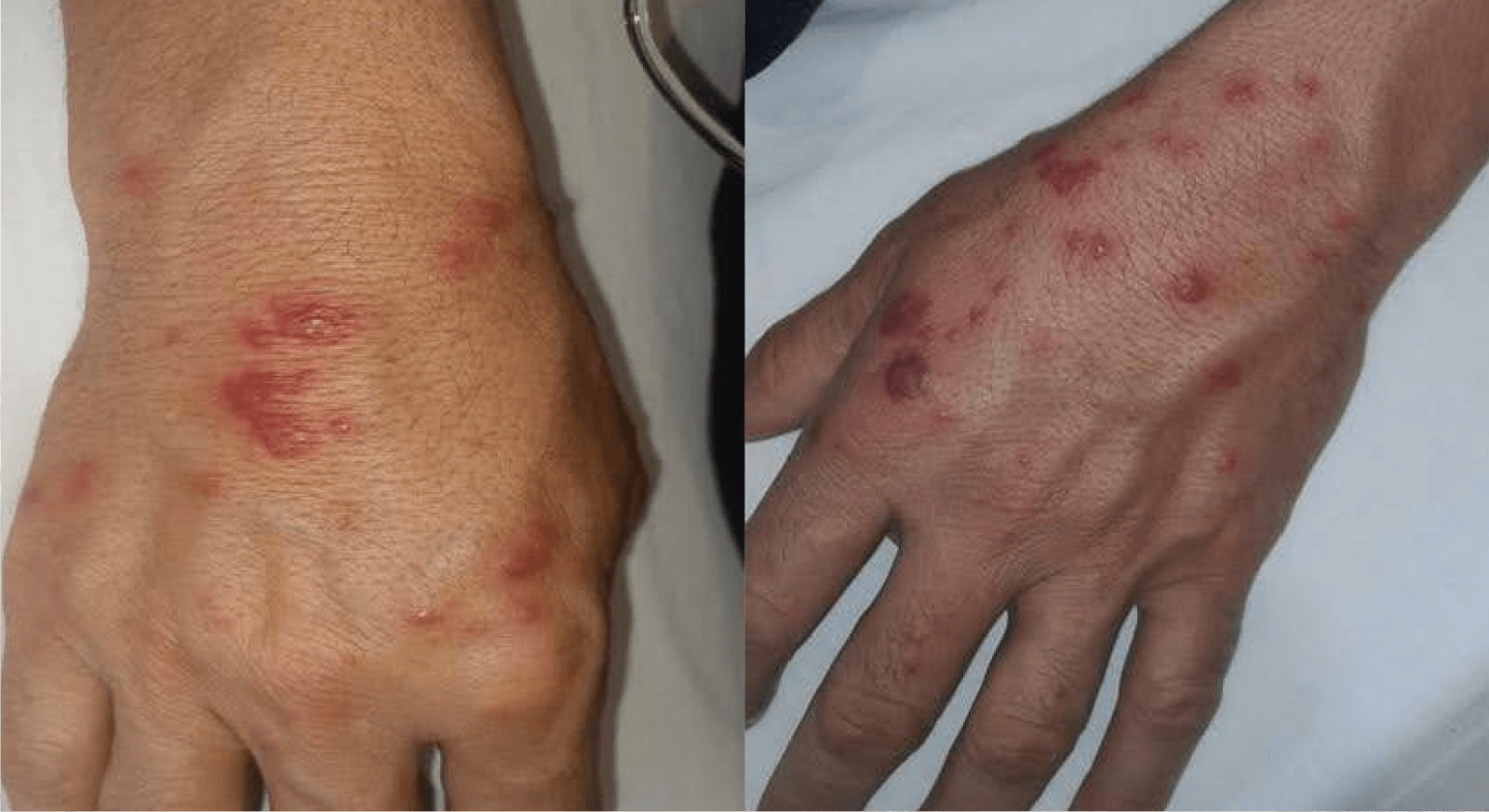 Rare skin manifestation of tularemia: Sweet syndrome