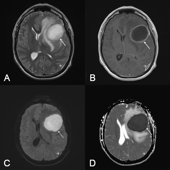 Cerebral abscess and epidural empyema caused by Streptococcus constellatus