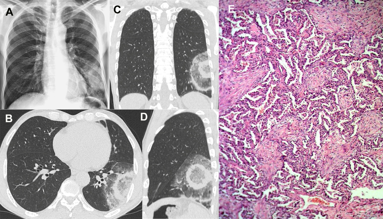 The CT target sign as a criterion for the differential diagnosis between tuberculosis and organizing pneumonia