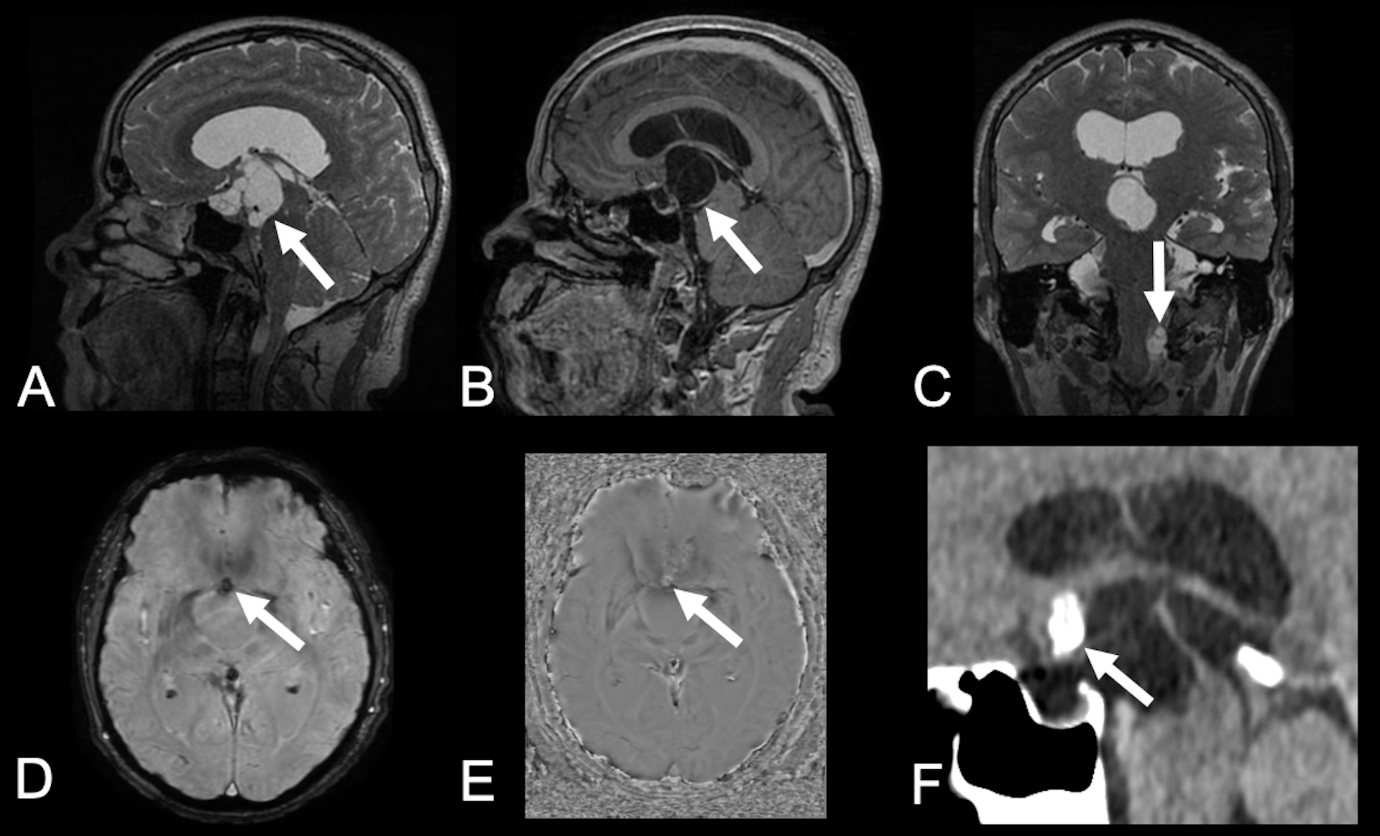 Racemose neurocysticercosis mimicking craniopharyngioma