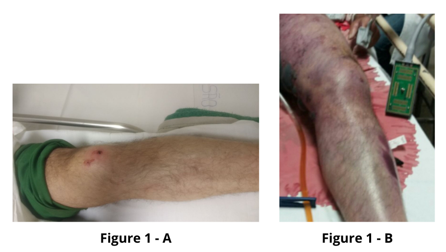 Secondary infection with Aeromonas hydrophila and death of two patients with probable Bothrops envenomation