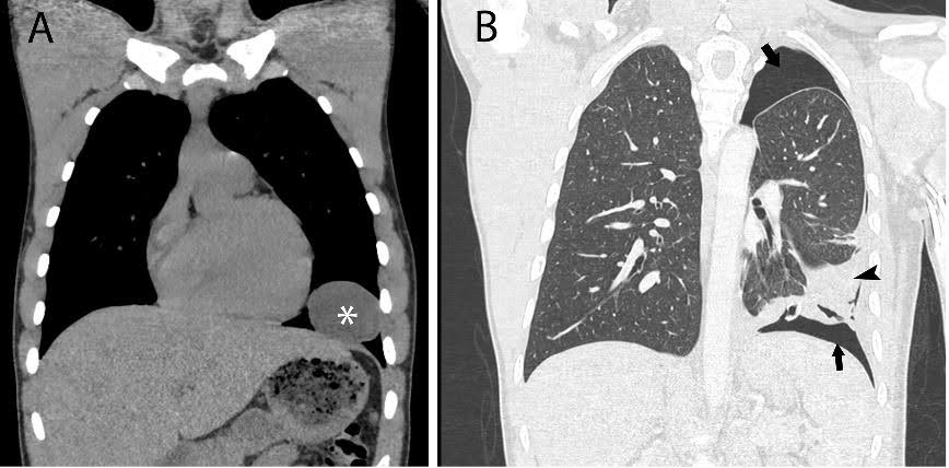 Hydatid Cyst Rupture Due to Albendazole Treatment