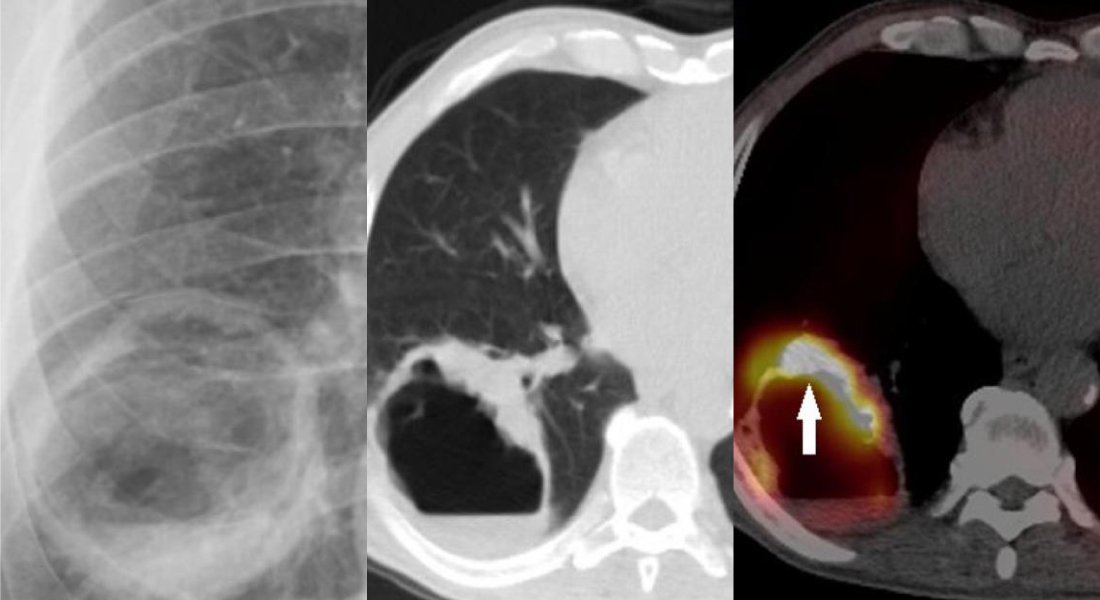 A Case Of Tuberculosis In The Cavitary Lesion Suggestive Of Neoplasm