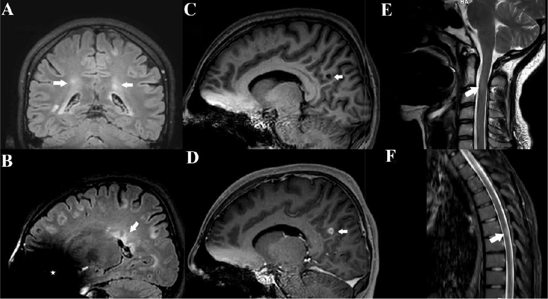 Neurobrucellosis and Multiple Sclerosis: Cause, Confounder, or Coincidence?