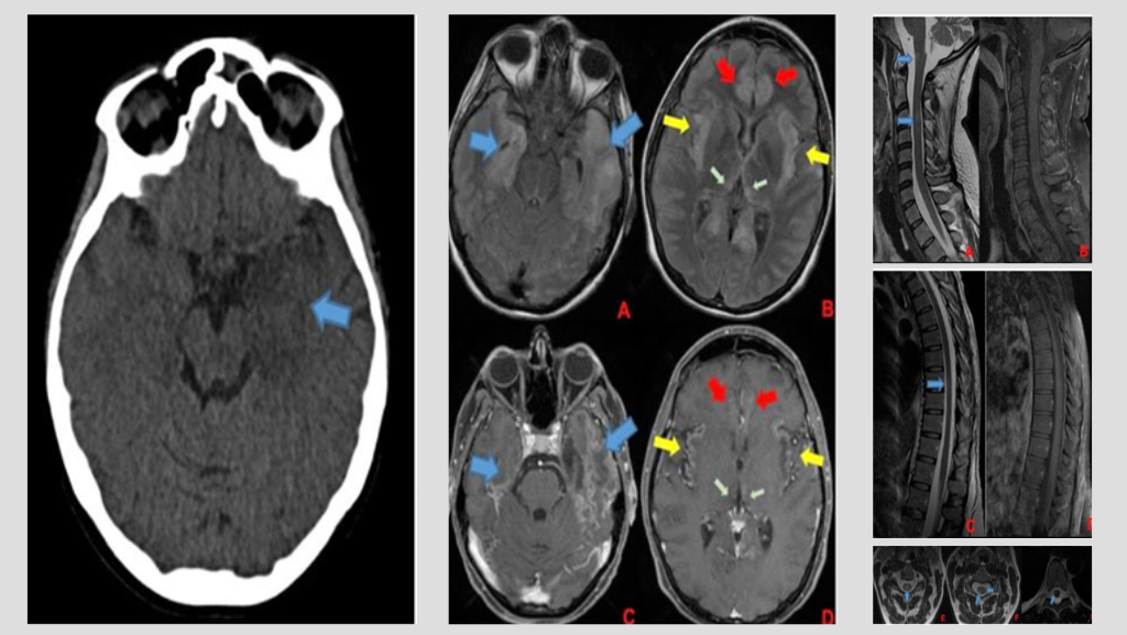 Postpartum Myelitis Following Dengue-Related Limbic Encephalitis