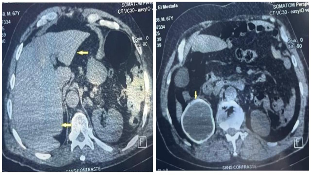 Primary Alveolar Echinococcosis of the Kidney
