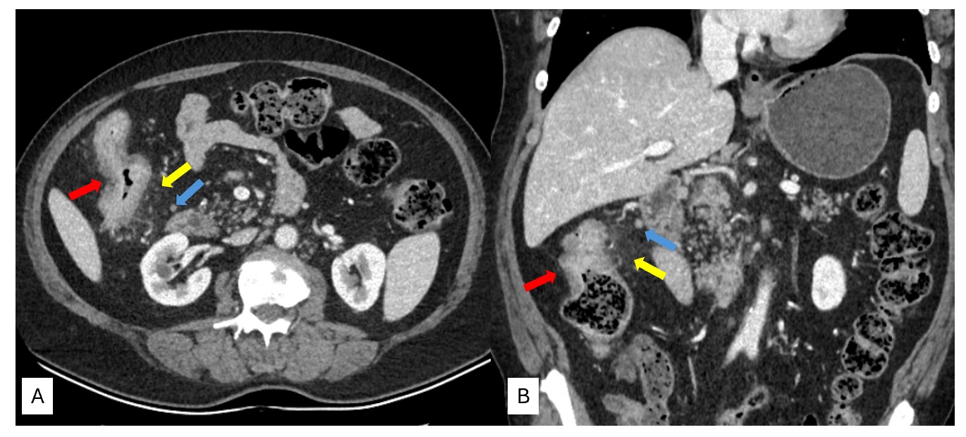 Figure 1. Axial (A) and coronal (B) computed tomography images showing thickening of the ascending colon wall (red arrows), pericolonic fat stranding (yellow arrows), and regional lymph nodes (blue arrows).