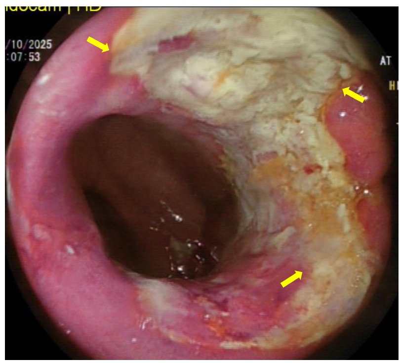 Figure 2. Colonoscopic image showing ulcerated lesions in the ascending colon covered with exudate.