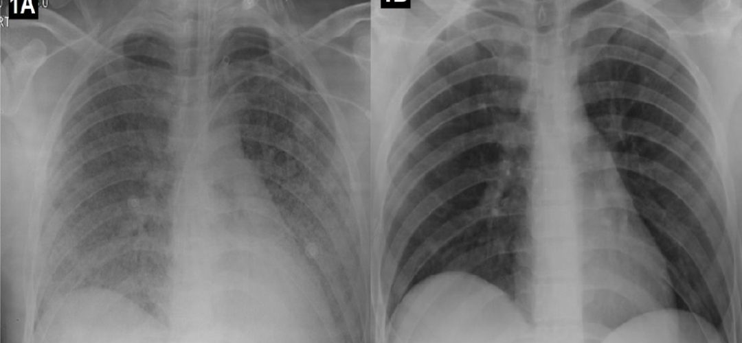 Chest radiograph showing mixed opacities distributed in the parenchyma of all four quadrants of both lungs, without consolidations (A); and complete resolution of the lung infiltrates following treatment (B)