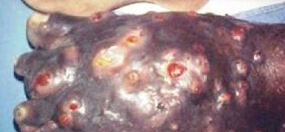 eumicetoma