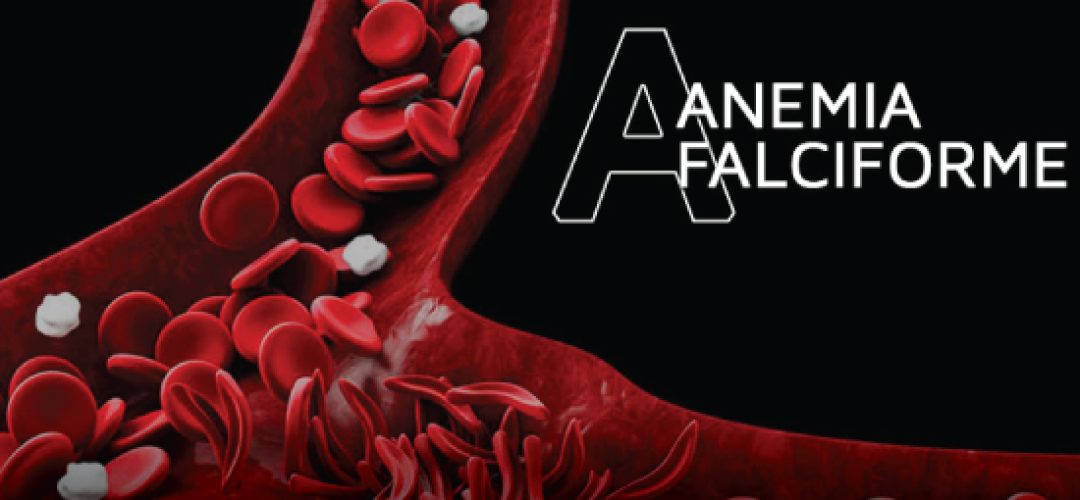 According to an unprecedented survey carried out by IBOPE Inteligência, 47% of the population claims they have never heard of Sickle Cell Disease