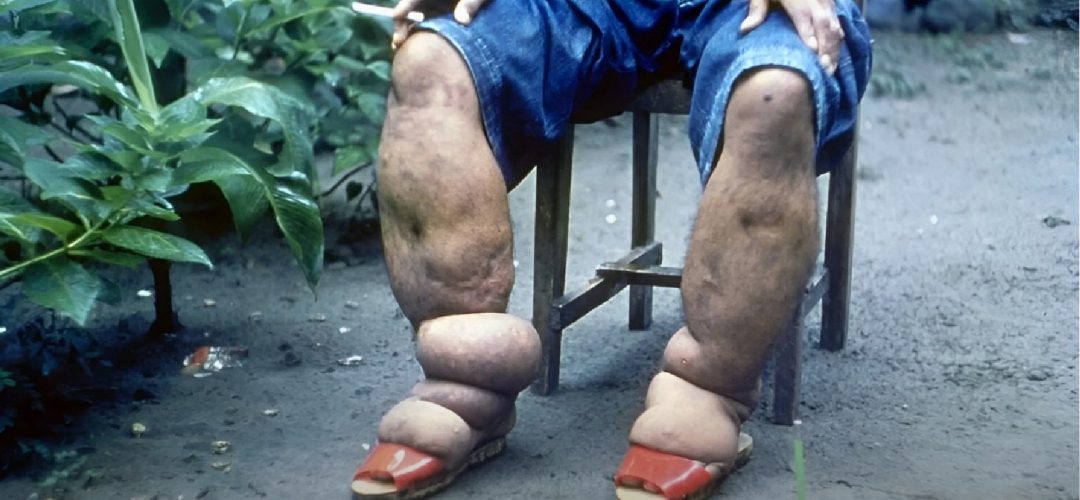 Concedida pela OMS, a certificação destaca o Brasil como o 20º país no mundo a eliminar a doença, reconhecida como uma das principais causas de incapacidade permanente ou de longo prazo