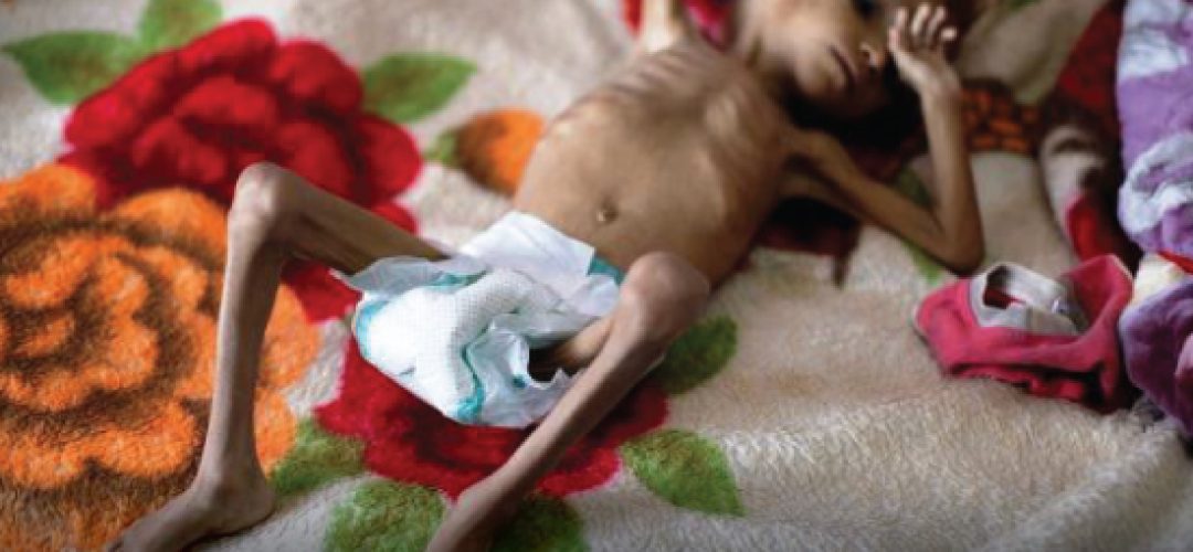 When it comes to hunger, the most affected people are those who live in conflict areas, such as the Yemen