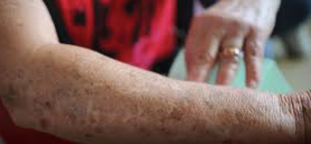 Políticas de saúde voltadas à prevenção e ao tratamento precoce do câncer de pele se fazem necessárias. A doença apresenta alta chance de cura, caso seja diagnosticada precocemente.