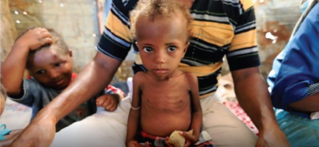 Em 2019, 47 milhões de crianças sofriam com a desnutrição, perda de peso e magreza extrema. Pandemia deve dificultar meta da ONU em erradicar a fome no mundo até 2030