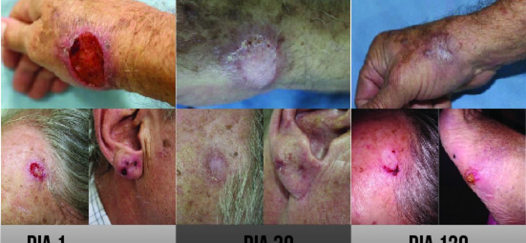 Alternatives for the treatment of the elderly with cutaneous leishmaniasis in basic health units