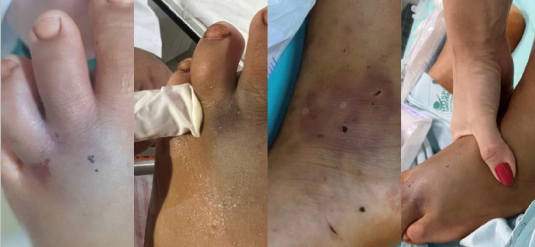 Photos taken at the University Hospital of Londrina showing the area of the possible bite. a, b) Two punctate lesions and hemorrhage points can be observed in the distal region of the third left metatarsal. c, d) Multiple lesions of unknown etiology on the left foot.