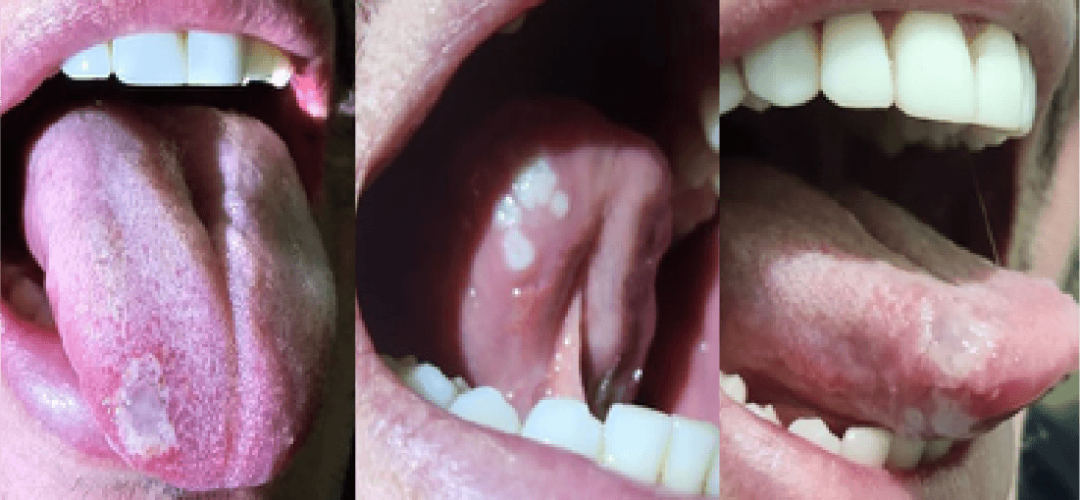 FIGURE 1: Umbilicated tongue lesions. A large lesion on the dorsum of the tongue with a pox-like appearance, whitish color, and translucent umbilicated center. Five smaller whitish umbilicated lesions are visible near the lingual frenulum on the left side of the tongue. Lateral view shows all tongue lesions.