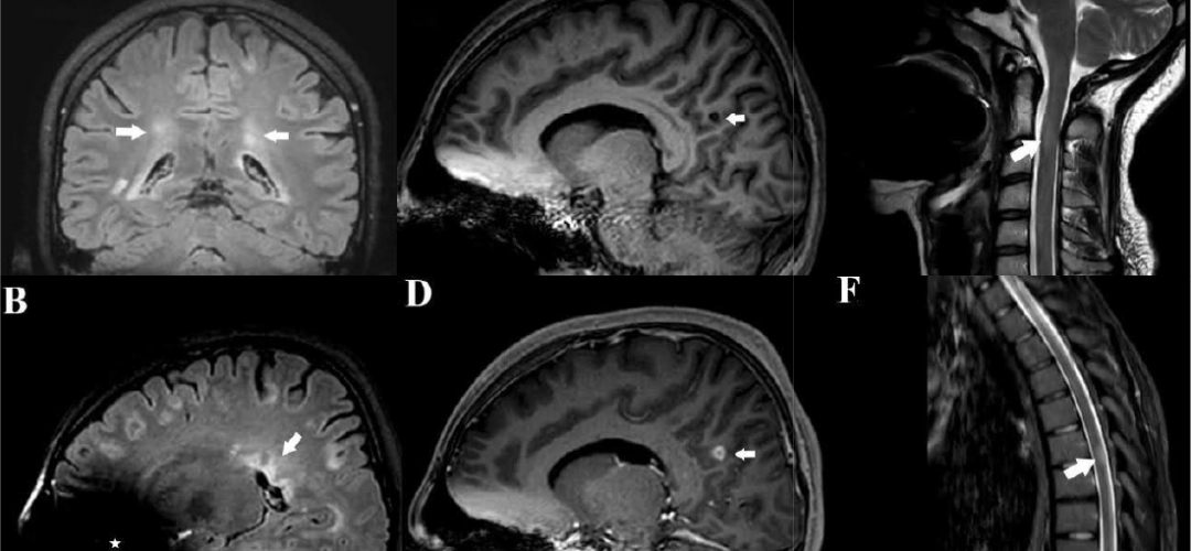 Case report underscores the diagnostic challenges in distinguishing between infectious and autoimmune demyelinating disorders, particularly in endemic regions, and highlights the importance of a comprehensive evaluation of atypical presentations