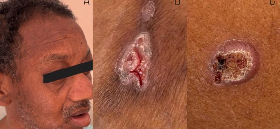 This case report describes a 47-year-old man with osteocutaneous involvement diagnosed by biopsy and direct fungal examination. The osseous form of PCM is rare and should be differentiated from other infections and neoplasms. Management involves prolonged antifungal therapy and follow-up for at least two years