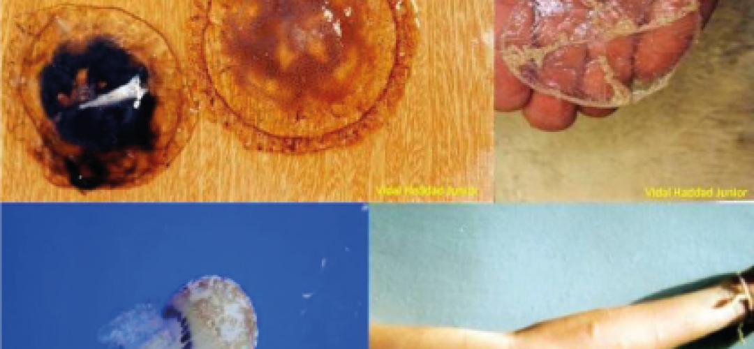 In the upper left: Chrysaora lactea, the jellyfish linked to the mass accidents in the South region. In the upper right, Olindias sambaquiensis, another jellyfish involved in mass accidents, however, in lower scale. In the bottom left, Lychnorrhiza lucerna, common in the area, but not involved in the accidents. In the bottom right: typical accident by Chrysaora or Olindias, with irregular and non-linear marks.