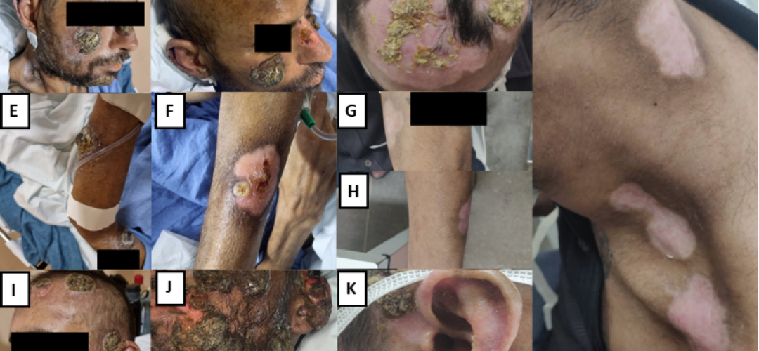mpox in patients-1